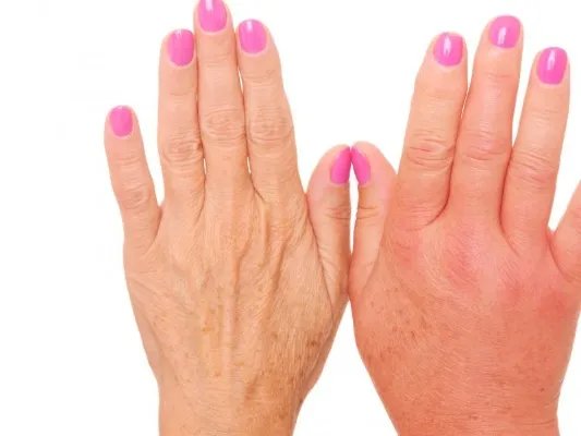 女人怎样保养手部皮肤