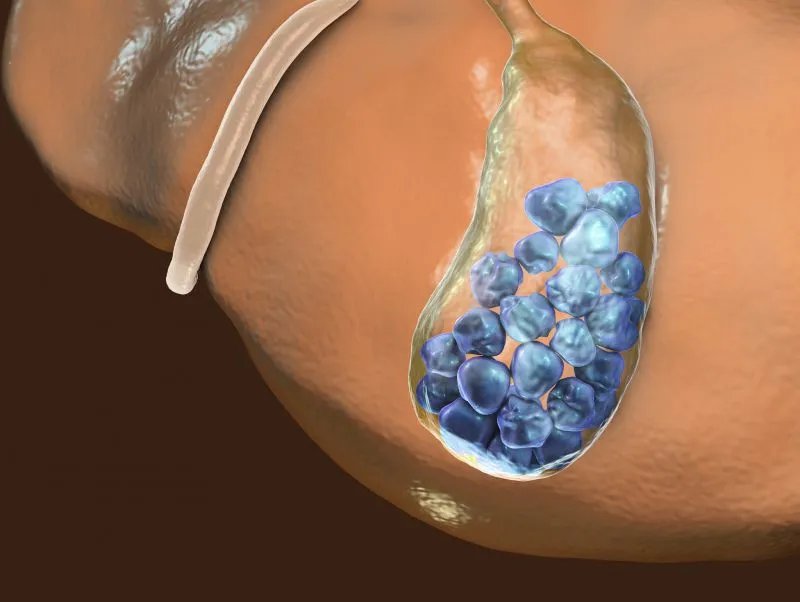 南瓜藤能治胆结石吗