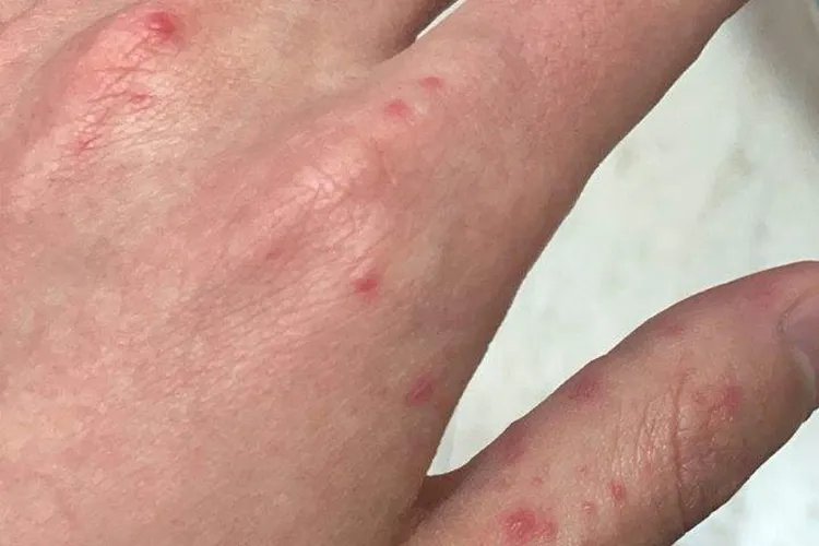 大人得手足口病症状初期图片