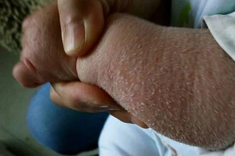 新生儿鱼鳞病初期症状图片