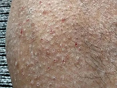 慢性湿疹小腿症状图片