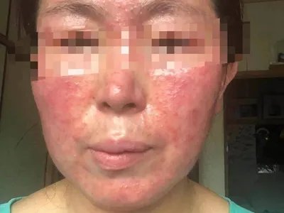 战壕热症状图片