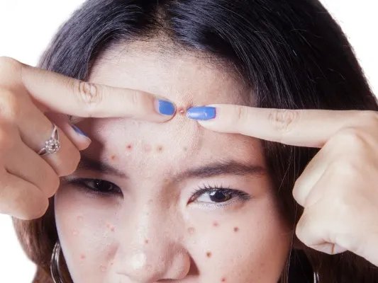 吃什么能去黄褐斑