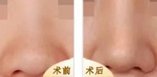 假体隆鼻术后有哪些注意事项？看了这些你就知道了！