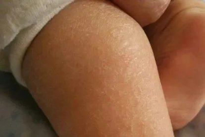 2个月婴儿皮肤干燥图片