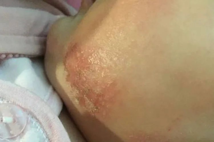 宝宝湿疹图片