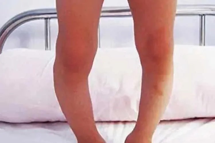 小宝宝佝偻病症状图片