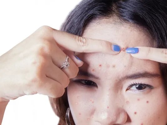 脓包痤疮怎么治