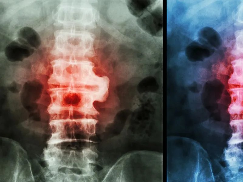 强直性脊柱炎的后果有哪些