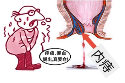 痔疮患者图片