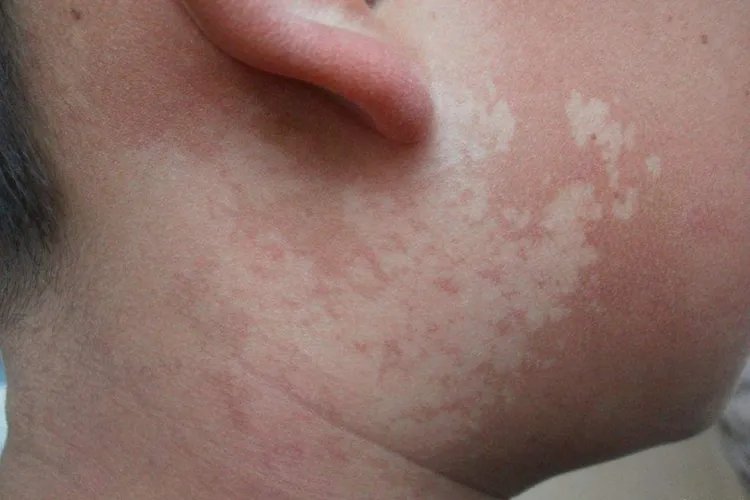 白斑初期症状图片是什么样