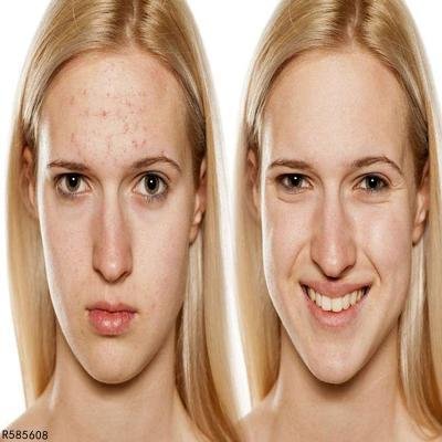 西红柿可以祛斑吗 哪些方法可以祛斑