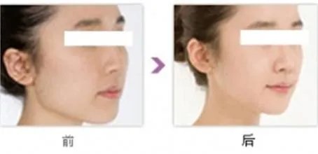 打针去皱纹多少钱