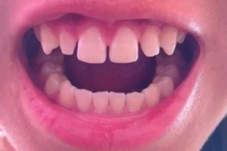 需要矫正的牙齿类型图片