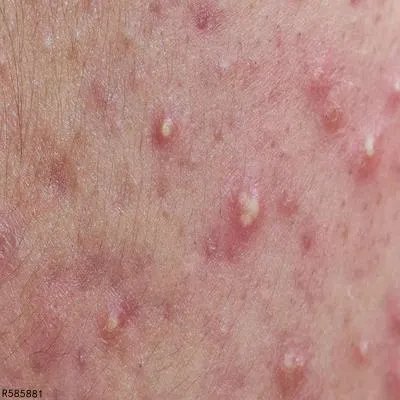 痤疮疤痕怎么去掉