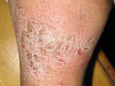 慢性湿疹小腿症状图片