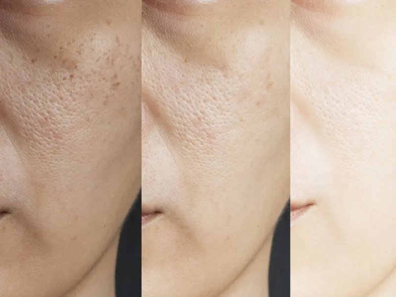 激光全身美白效果