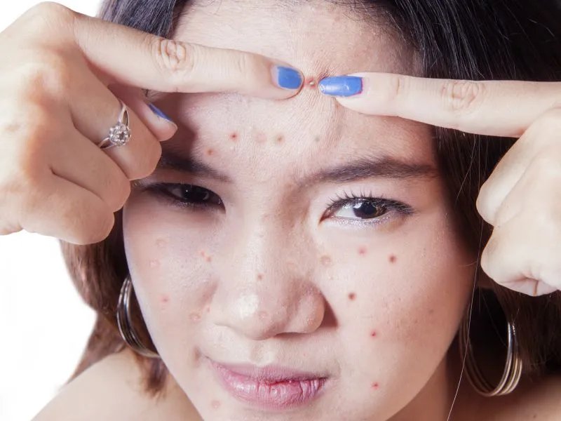 痘痘女孩需要注意