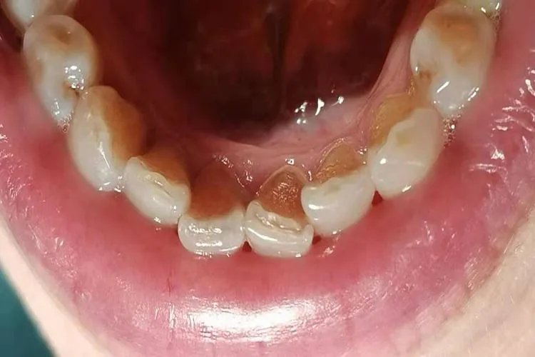 牙石是什么样的