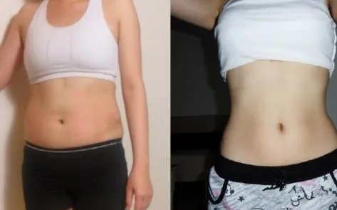 溶脂手术多少价格