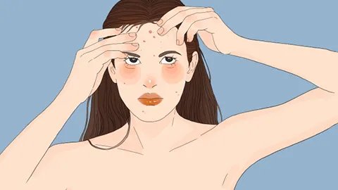 果酸换肤可以去痘吗