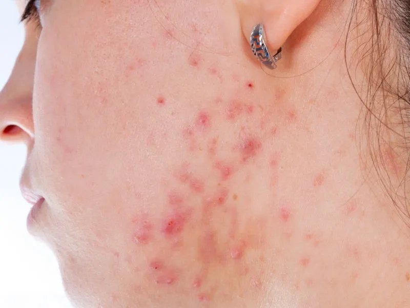 如何治疗痤疮痘坑