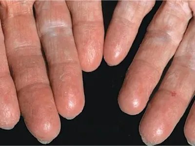 进行性指掌角皮症竖纹图片