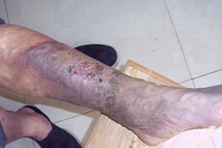 炭疽病皮肤发紫图片