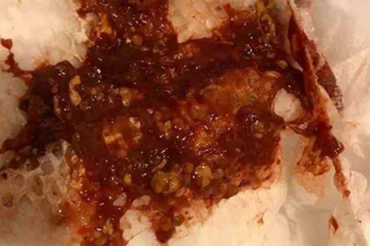 炭疽病腹部症状图片