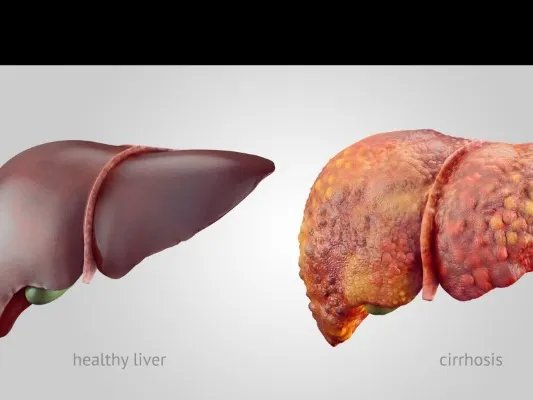 肝癌的治疗方法