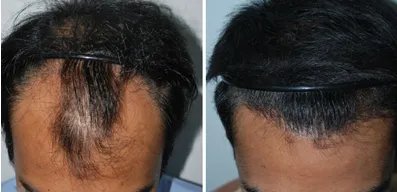 种植头发要多少钱