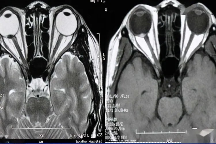 视网膜母细胞瘤图片