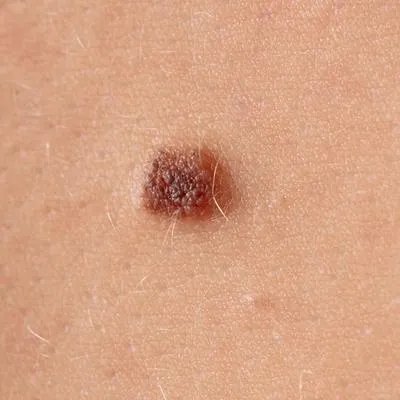 黑痣变大突起怎么回事 黑痣变大突起的两个原因分析