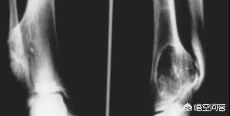 脚扭伤了怎么好的快?