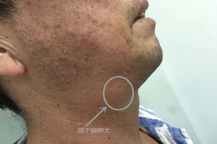 腮腺炎的症状图片