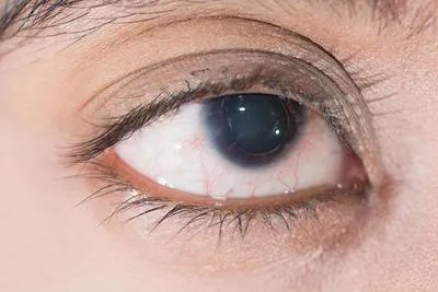 角膜云翳和角膜斑翳如何区别