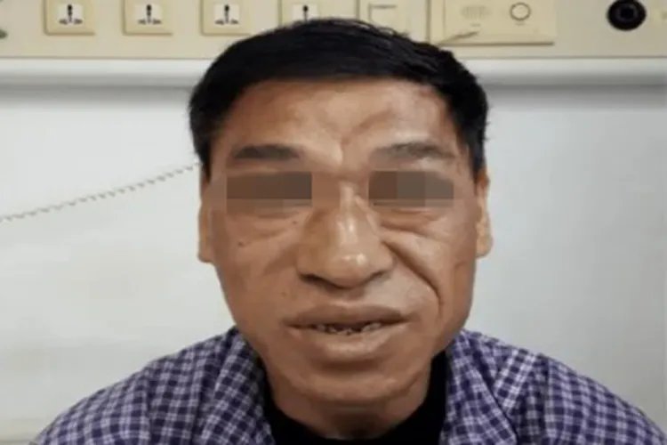 肢端肥大症面部皮肤增厚图片