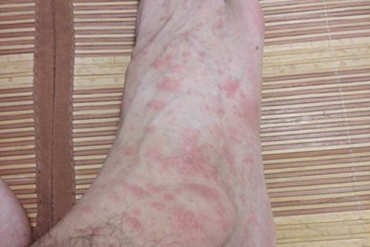 血吸虫病症状图片