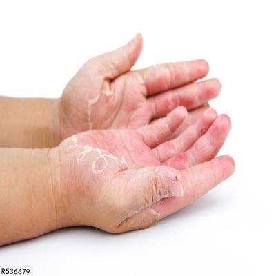 全身皮肤干燥脱皮是什么原因导致的