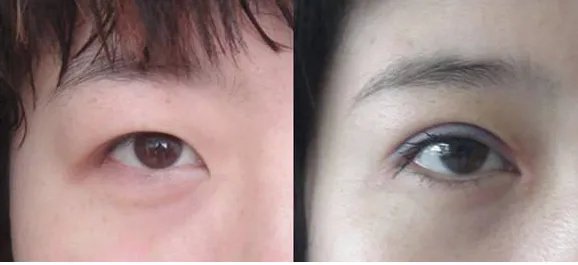 双眼皮埋线大约多少钱