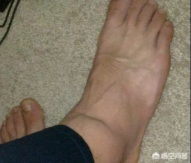 脚扭伤了怎么好的快?