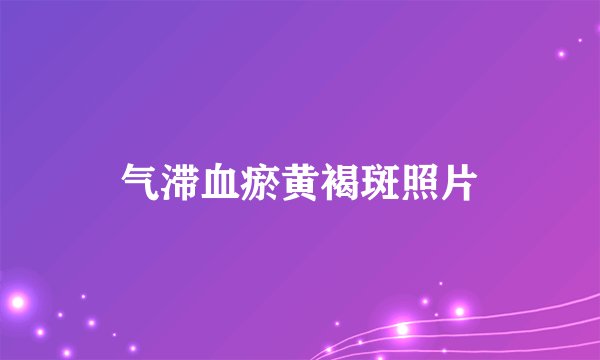 气滞血瘀黄褐斑照片