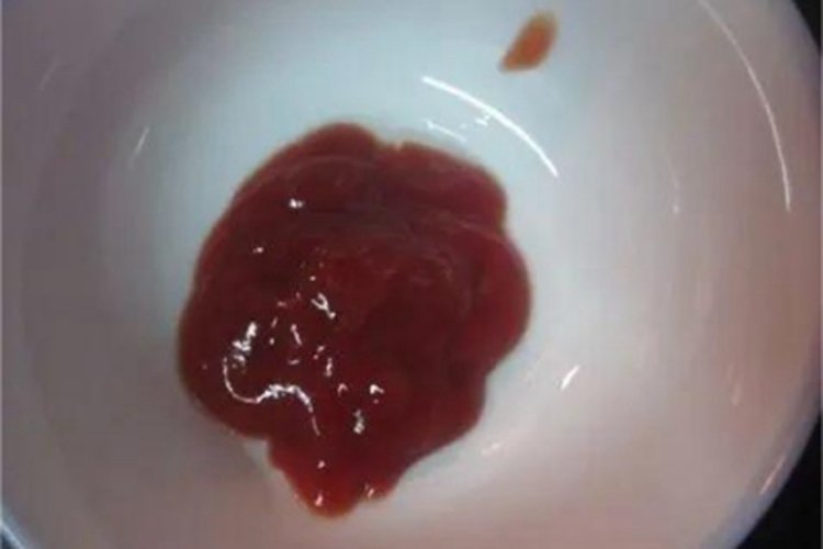 血吸虫病症状图片