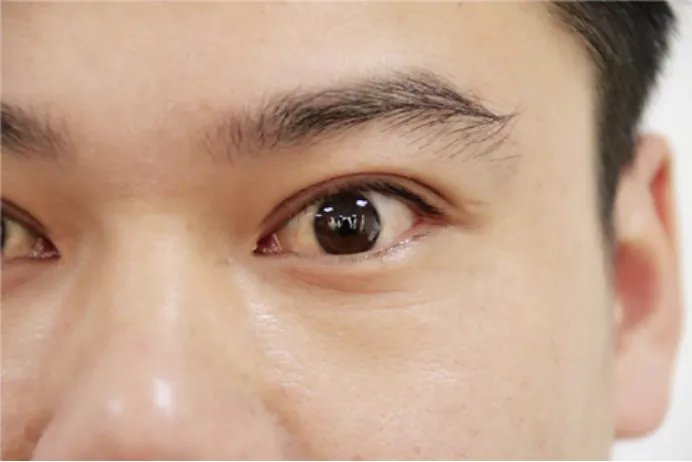 眼底出血是怎么回事