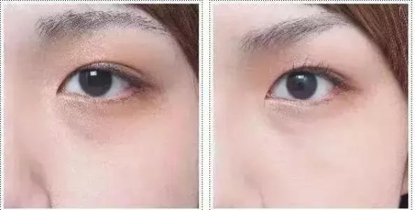 超声波去眼袋多少钱