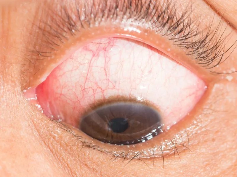 红眼病怎么预防