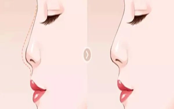 自体软骨隆鼻有哪些优点