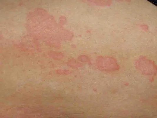 湿疹性皮炎症状？