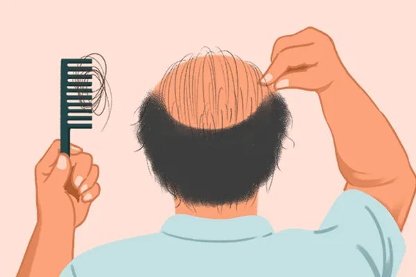 掉头发是什么原因引起的