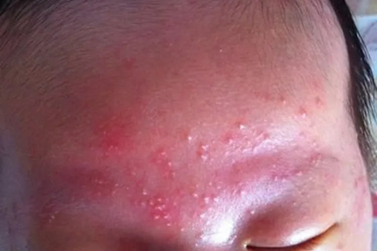 新生儿湿疹和痱子的区别图片